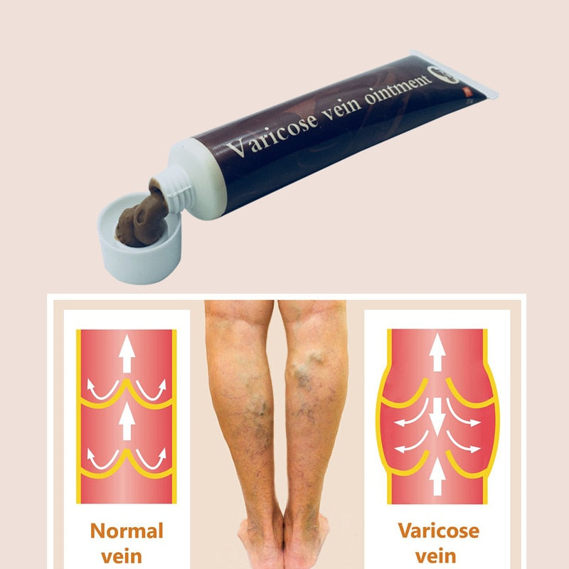 Best Varicose Veins Treatment Cream