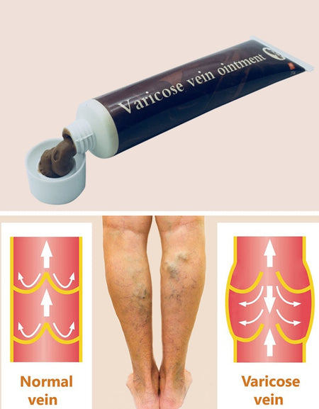 Best Varicose Veins Treatment Cream